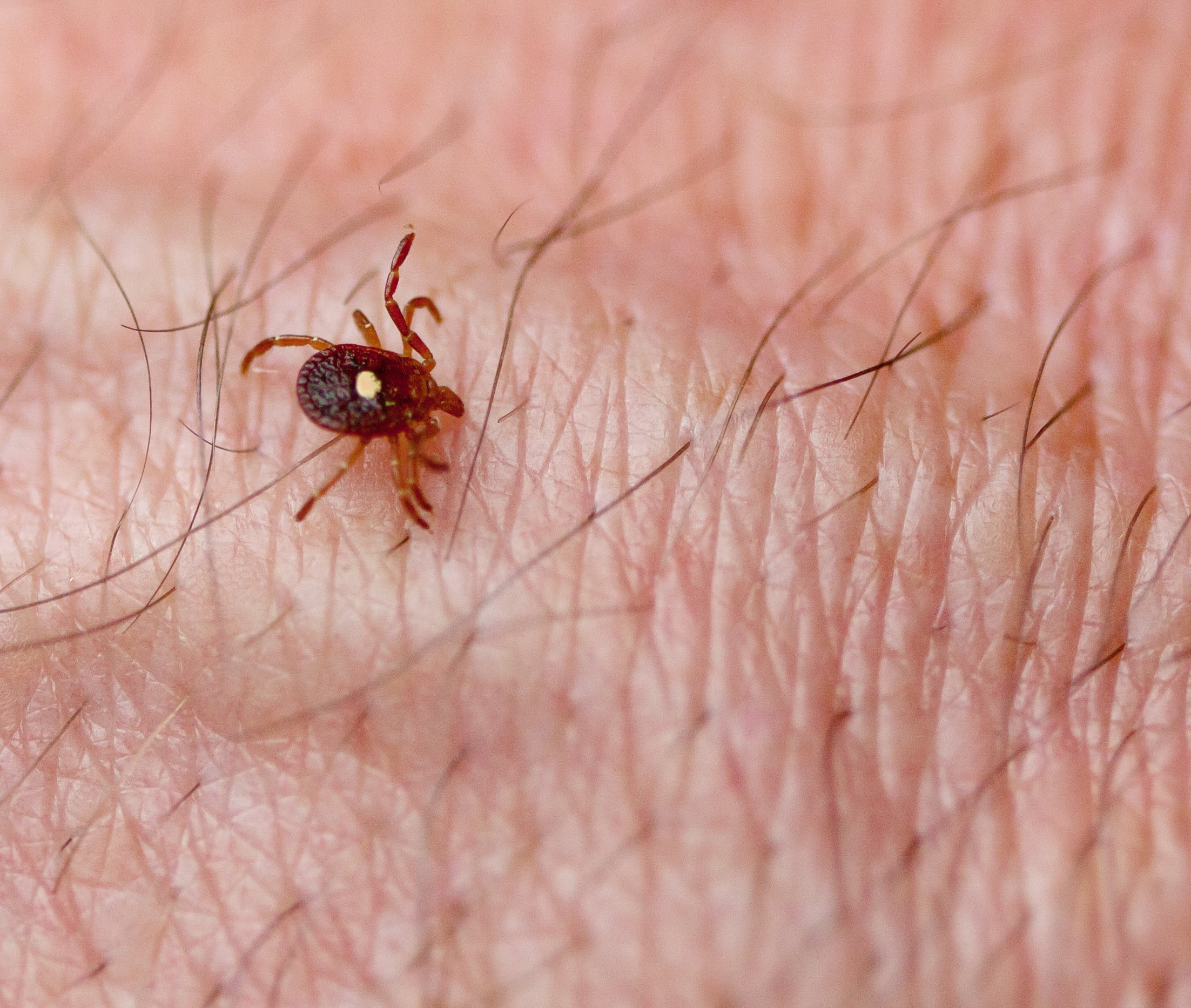 tick bite